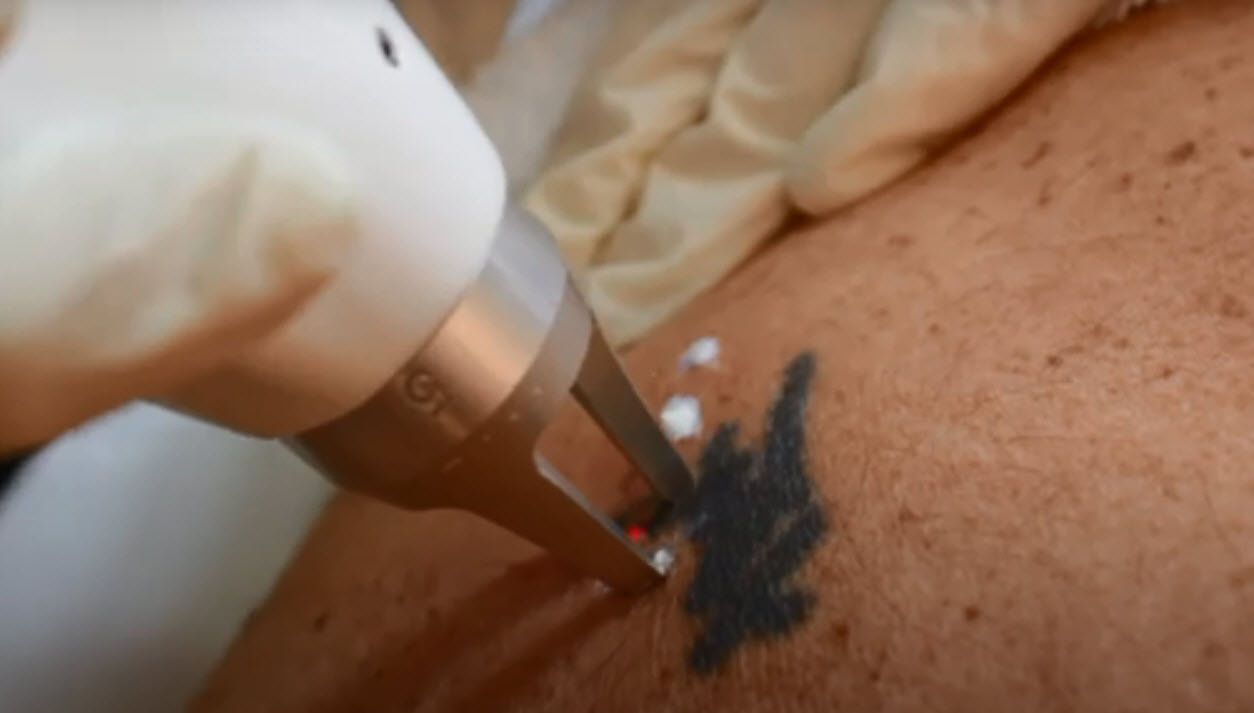 Laser tatoo remover